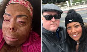 Woman suffers horrific burns after her husband accidentally set her