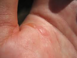 Far more brown recluse bites are reported than proven, and plenty of confusion remains about what these spider bites actually look and feel like. Signs Of A Spider Bite