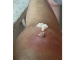 Pimple on labia, symptoms, and treatment; Ingrown Hair On Vag Archives New Pimple Popping Videos