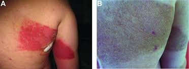 Image result for Radiation Dermatitis