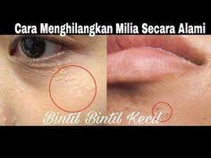 Cara Alami Sangat Ampuh Menghilangkan Milia Youtube Perawatan Kulit Masker Wajah Buatan Rumah Bau Badan