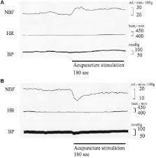 Figure 6 From Acupuncture Treatment For Low Back Pain And