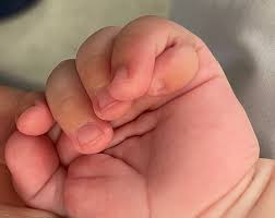 Image result for Polydactyly