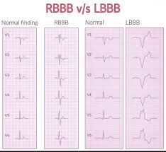 Image result for Right Bundle Branch Block