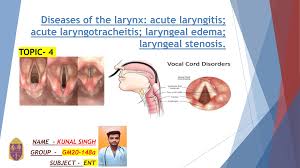 Image result for Acute Laryngitis