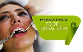 Pin On Wisdom Teeth Removal Surgery