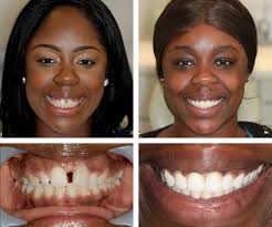 INVISALIGN CLEAR BRACES