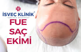 Sac Ekiminde Maksimum Greft Sacekimi Sac Greft Isvecteknigi Sacsizlik Sacdokulmesi Hairtransplant Sac Sacekimi Sac Sac Dokulmesi Isvec
