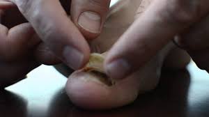 Ako se na noktu pojavljuju žute, smeđe ili crne mrlje i pruge, to je signal gljivične infekcije. Modrice Ispod Noktiju Uzroka Podnogo Hematoma Ozljeda Noktiju Dijagnoza I Lijecenje Modrice Ispod Nokta Palca