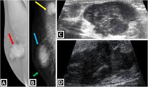 Inflammatory breast cancer is a rare type of breast cancer that develops rapidly, making the affected breast red, swollen and tender. Imaging Findings And Classification Of The Common And Uncommon Male Breast Diseases Insights Into Imaging Full Text