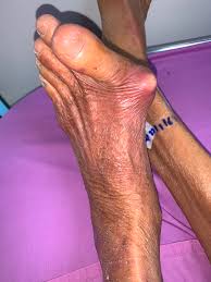 Image result for gout