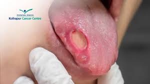 Image result for cancer of tongue