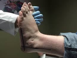 Keys To Managing Heel Pain In Basketball Players Podiatry Today