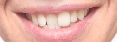 Schiefe Zahne Kosten Behandlung Risiken Mooci