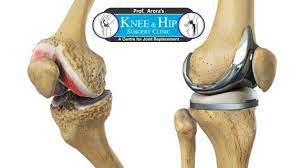 Joint Replacement Surgeon Delhi Joint Replacement Knee Replacement Hip Joint Replacement