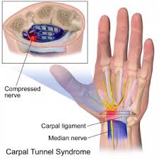 Image result for Carpal Compression Test