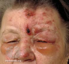 Image result for herpes zoster