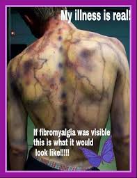 Fibromyalgi - Emschen