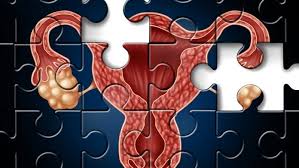 What are the signs & symptoms of ovarian cancer? mayo clinic: Ovarian Cancer Metastasis Aided By Dna Webs