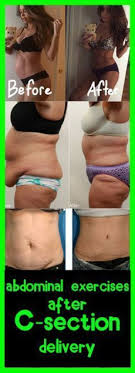 Abdominal Exercises After C Section Delivery Looseweight After C Section Workout C Section Workout Diastasis Recti Exercises