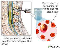 Image result for CSF Culture