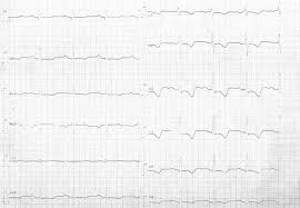Signs and symptoms of mild to moderate lithium toxicity include Lithium Intoxication Related Multiple Temporary Ecg Changes A Case Report Cases Journal Full Text