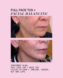 mini facial balancing by @kkraesthetics subtle enhancements to the  mid-face, lower face (pre-jowl and chin), and lip hydration 😍 mini facial  balancing is a treatment consisting of 3.5 syringes strategically placed in