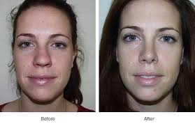 In this case the tip of the nose has a round appearance, although it does not grow a lot in size. Bulbous Nose Tip After Rhinoplasty
