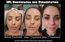A IPL PhotoFacial is an FDA approved, non-invasive skincare treatment that  utilizes light-based technology to help diminish the signs of aging, treat  sun damage, Rosacea and vascular imperfections and correct hyper  pigmentation.