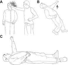 X Post From Videos Is This Guy Decorticate Posturing At The Very End Ems