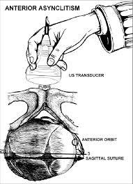 Transabdominal Ultrasound In Transverse Fetal Head Position