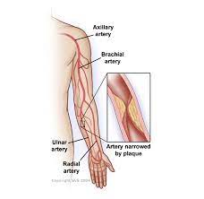 The arteries of the anterior and posterior compartments of the arm are branches of the brachial the diagram also shows that the brachial artery terminates just below the elbow joint as the radial and. Arm Artery Disease Society For Vascular Surgery