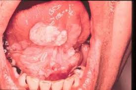 The sensation of a lump in the throat is called globus. Mouth And Throat Cancer Ear Nose And Throat Disorders Msd Manual Consumer Version