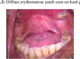 Image result for Erythroplakia roof of mouth