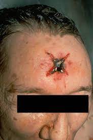 Gunshot wounds result from the discharge of projectiles by firearms. Forensic Pathology