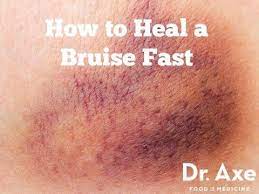 How To Get Rid Of Bruises 10 Natural Remedies Dr Axe Home Remedies For Bruises Heal Bruises Faster Heal Bruises