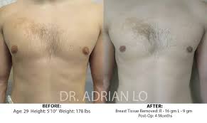 Image result for Gynecomastia