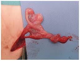 Image result for Undescended Testicle