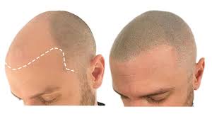 Stratford motor products stratford gm in stratford has new and used gm cars and suvs for sale. Frequent Questions And Answers About Smp Scalp Micropigmentation