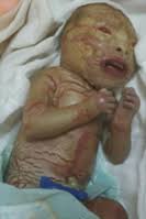 Raw, or with the top layer of skin rubbed off. Harlequin Type Ichthyosis Wikipedia