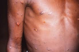 Monkeypox is a rare disease that is caused by infection with monkeypox virus. Monkeypox Outbreak Fears As Cdc Monitors 200 People In 27 States For Possible Exposure After Contact With Infected Texan