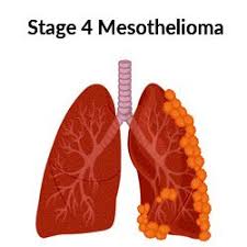 By classifying mesothelioma into different stages doctors can choose the best treatment plan for the patients. Stage 4 Mesothelioma Life Expectancy Palliative Treatments