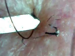 Do it in a circular motion. Black Dots Destroyed Hairs In The Hair Follicle Opening 01 å††å½¢è„±æ¯›ç—‡ Youtube
