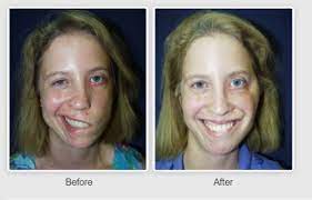 Many fellow sufferers of bell's palsy wrote in to share their stories. Is Bell S Palsy Treatment Covered By Insurance