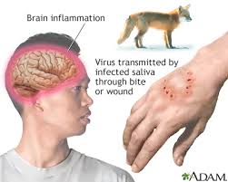 Rabies usually presents in humans with irritability, headache, a fever, and itching. Rabies Information Mount Sinai New York