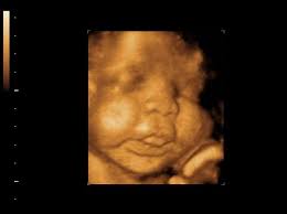 Stupid Comment By Ultrasound Tech Made Me Think My Son Has Downs Syndrome Babycenter