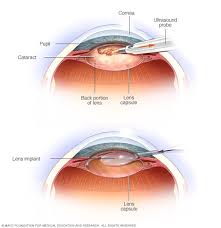 Most patients are back to normal activities the next day. Cataract Surgery Mayo Clinic