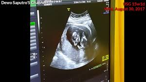Karena bayi sudah bisa memberikan respon, baik dengan tertawa, tersenyum, sampai mulai berceloteh sendiri. Usg Janin 4 Bulan Usg 2d 4d At 15w1d Wed Aug 30 2017 Baby Say Hello Running 1st Pregnancy 3 Youtube