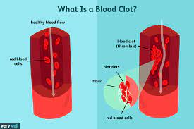 Clots form in response to injuries and can also be caused by many illnesses, including cancer and genetic. Blood Clots Overview And More
