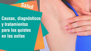 Salud Que Hacer Si Detectamos Un Bulto En La Axila Youtube